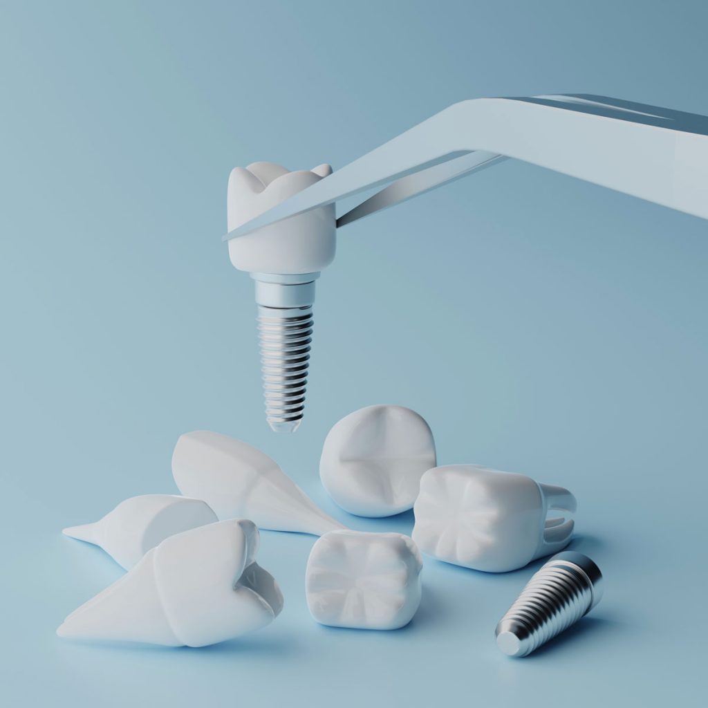 Dental implants