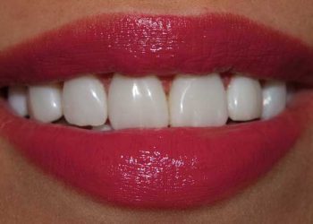 Veneer dentist