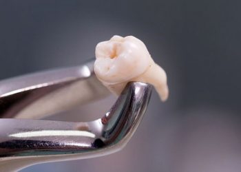 Wisdom Tooth Removal