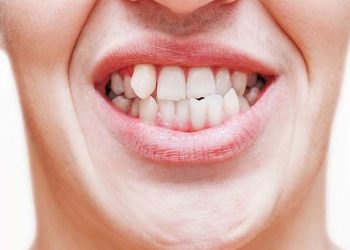 Crooked and Misaligned Teeth