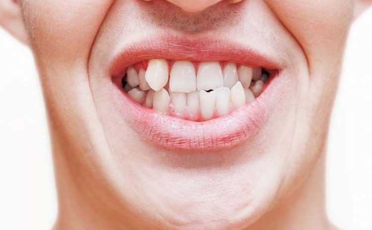 6 Causes of Crooked and Misaligned Teeth You Should Know