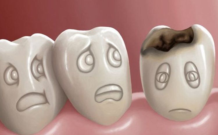  Cavities (Tooth Decay): Symptoms, Causes & Treatment Options