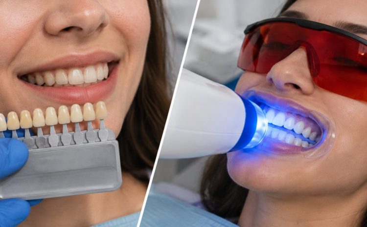  Dental Veneers vs Teeth Whitening: Which Is Right for You?