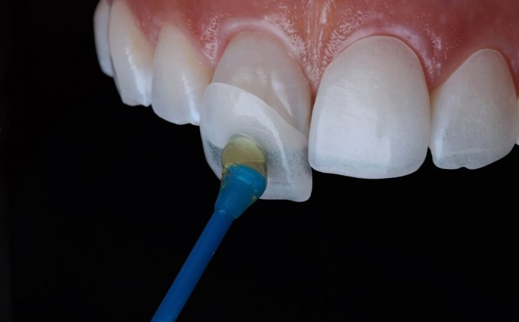  Who is a good candidate for Dental Veneers?