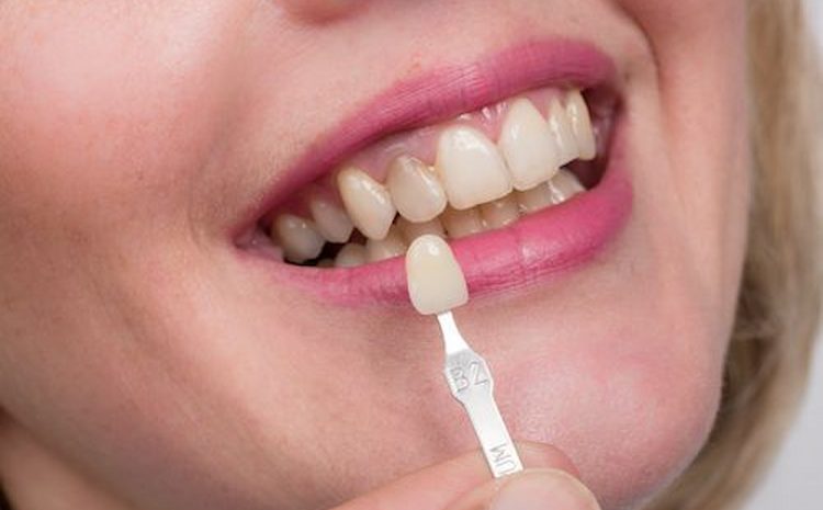 Dental Crowns and Bridges