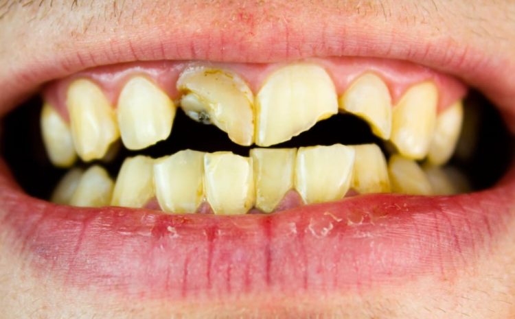  Dental Treatment Options for Cracked Tooth Repair