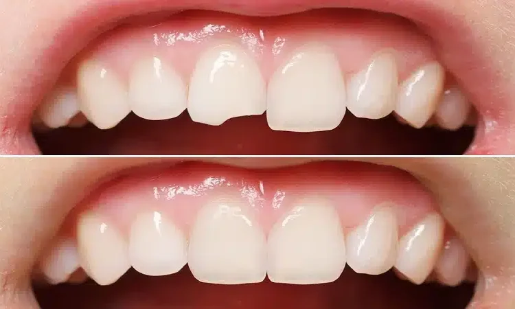  Dental Bonding: How It Is Done, Advantages and Disadvantages