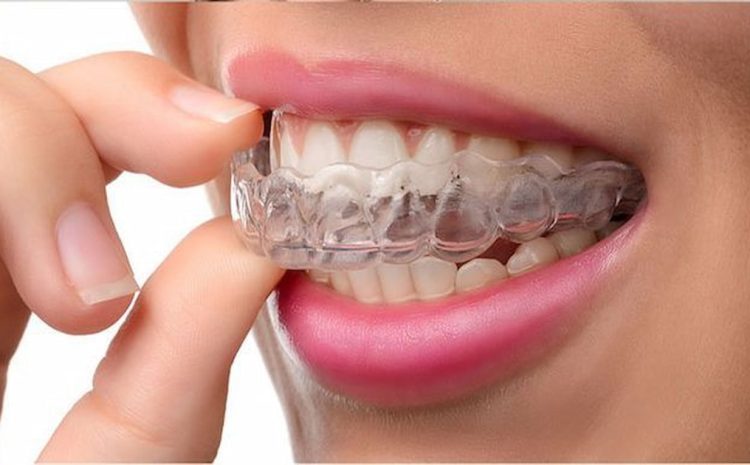  Chewing Gum with Invisalign: Is It Possible?