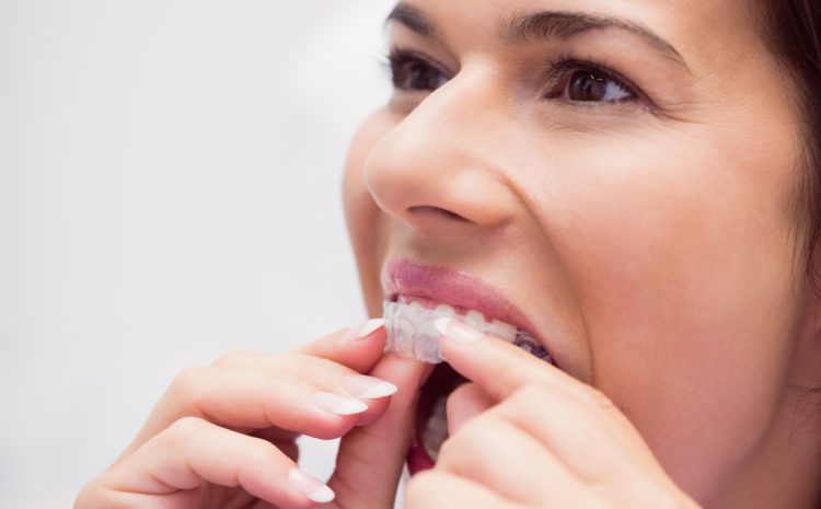  How Does Invisalign Work? A Complete Step-by-Step Guide