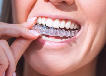 Why Invisalign is the Best Choice for Clear Aligners