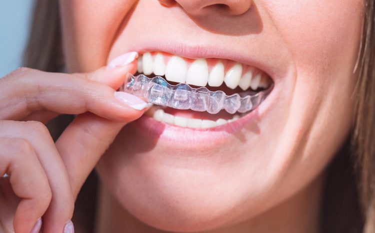  Why Invisalign is the Best Choice for Clear Aligners
