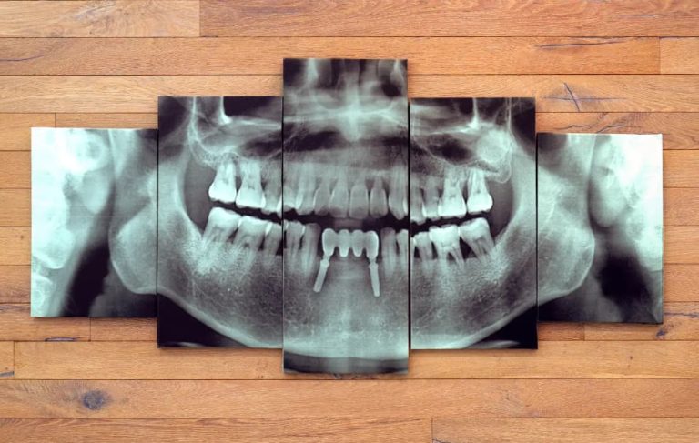 How Much Do Dental Implants Cost in Oakville?