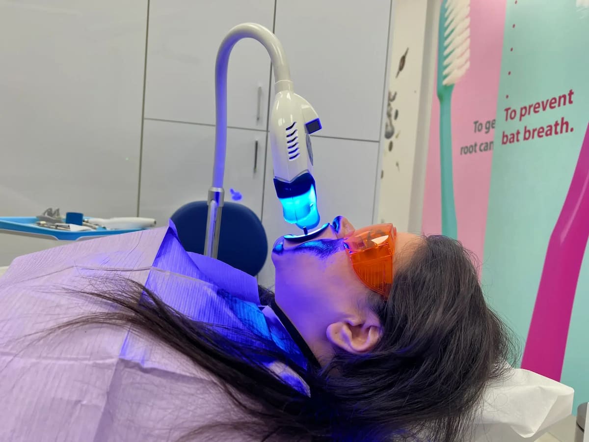 Zoom whitening before and after at Smile Point Dental Oakville