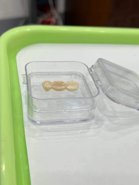 Dental bridge result, Smile Point Dental Oakville