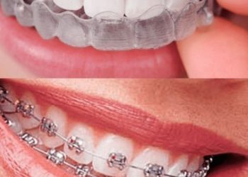 Best Invisalign Alternatives: Cost and Effectiveness Explained