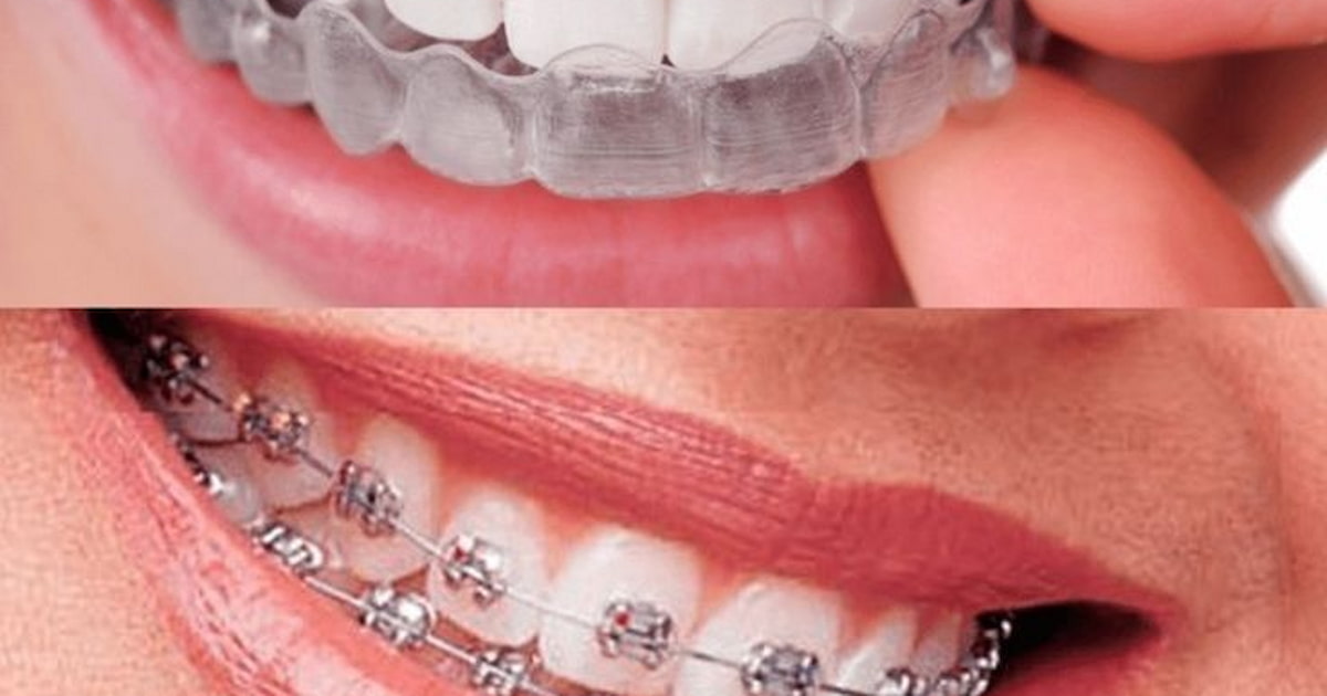 5 Best Invisalign Alternatives: Cost vs. Effectiveness
