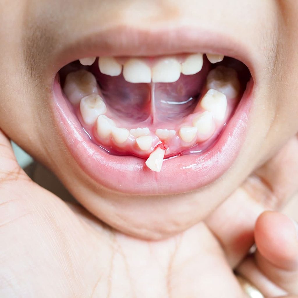 Broken Orthodontic Devices?