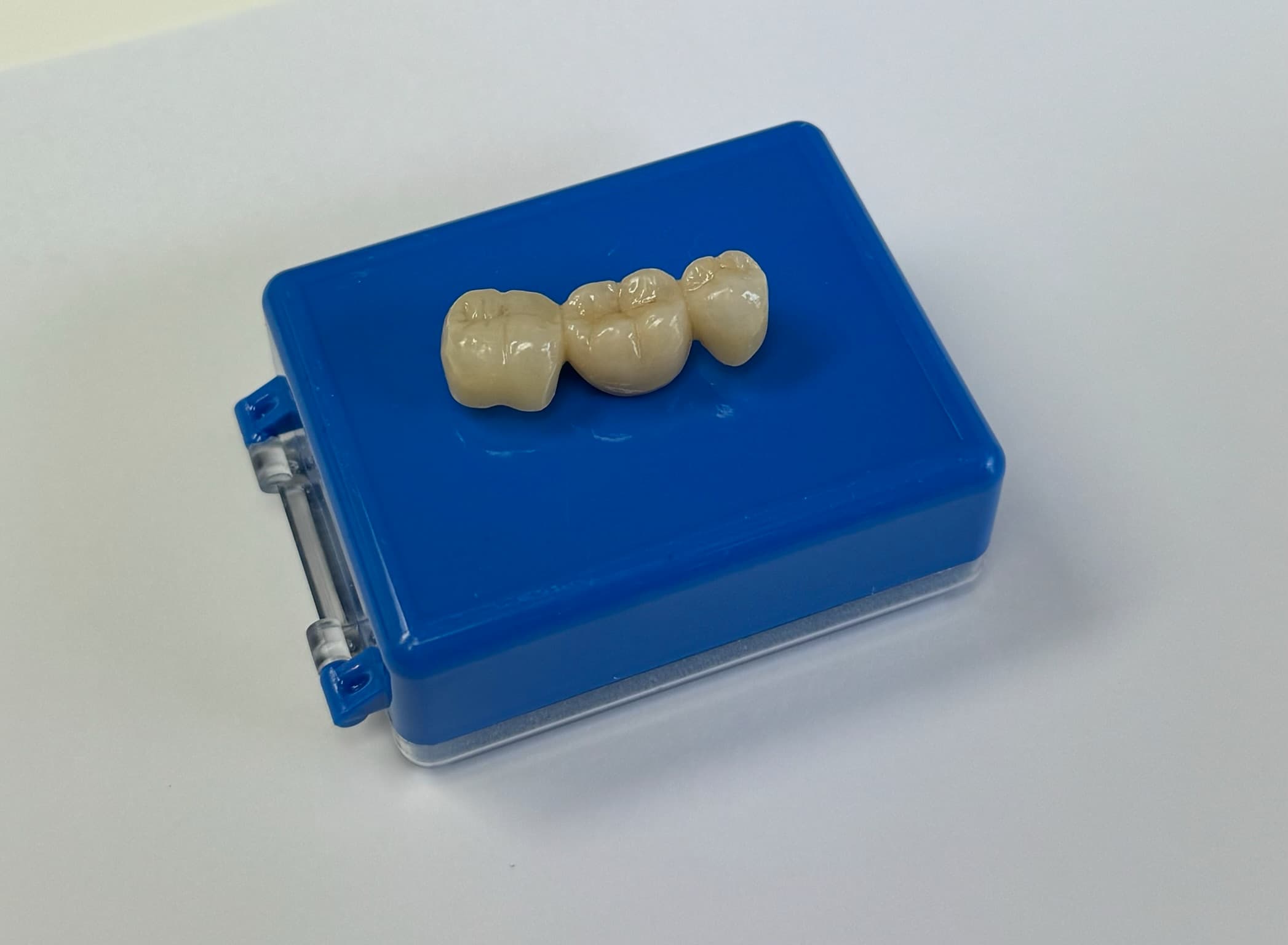 Dental bridge before and after at Smile Point Dental Oakville