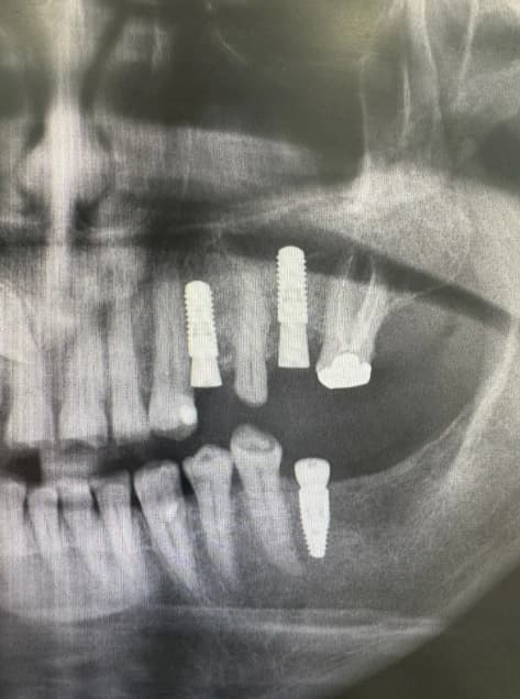What to Expect During the Dental Implant Process