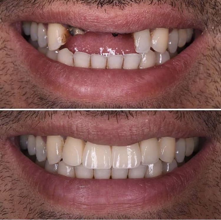 Is a Front Tooth Implant Different From Other Implants?