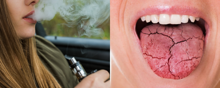 Vaping and Dry Mouth: A Common Oral Issue.