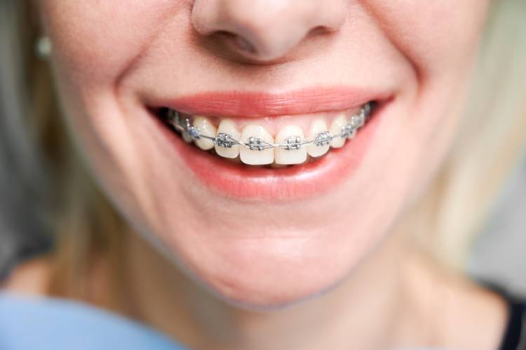 Woman’s smile with metal braces representing braces cost in Canada.