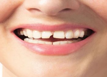 Repairing a Chipped Tooth