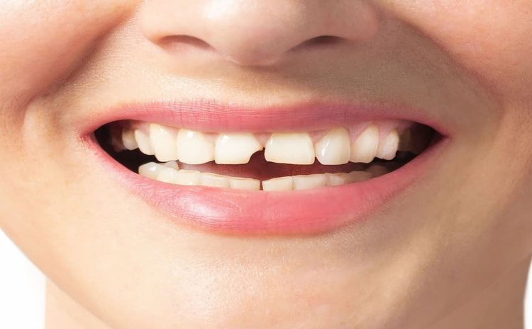  Emergency Cracked Tooth Repair: A Complete Guide to Repairing a Chipped Tooth