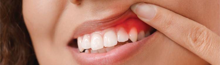 The photo shows infection and patient wants to know how to treat dental abscess