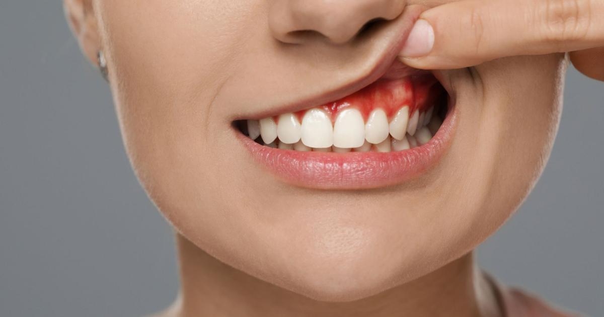 How to Treat Dental Abscess – Complete Guide for You