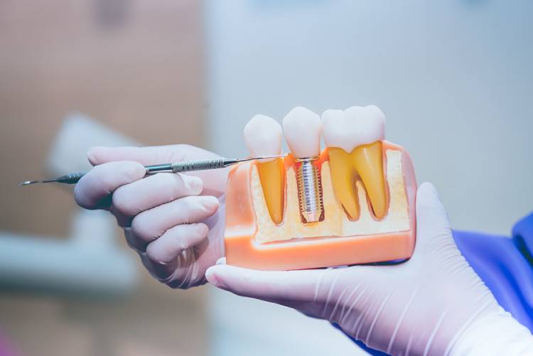 Dentist shows the process of dental implant ans explains dental implant cost