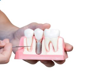 How much dental implant cost?
