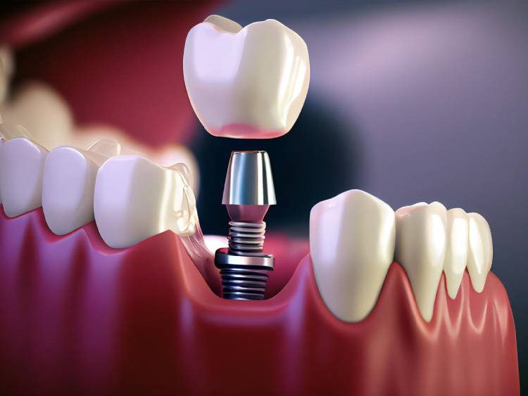 Dental implant process and dental implant cost