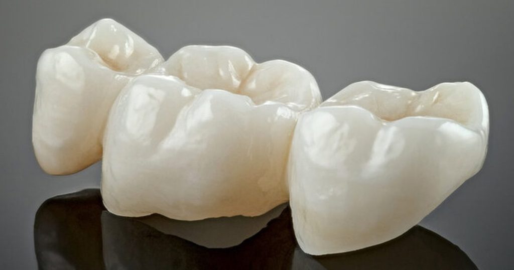 dental crowns lifespan