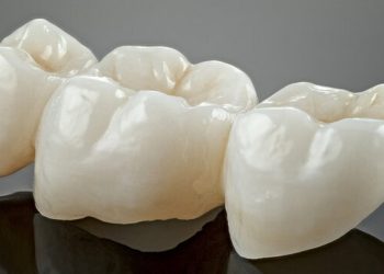 dental crowns lifespan