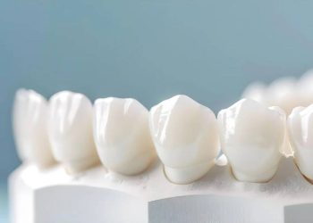 Full guide on overhanging dental crown
