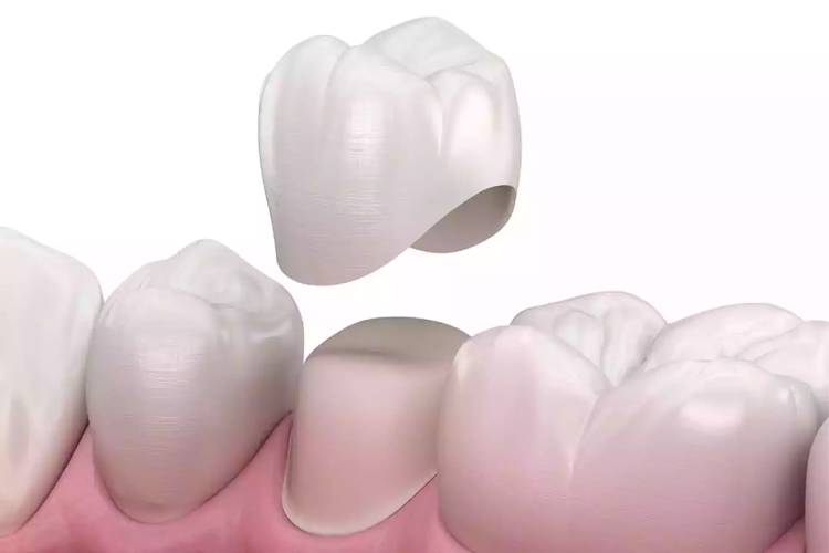 Overhanging dental crown; everything you need to know 