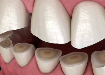 Night guard for grinding; tips you should know