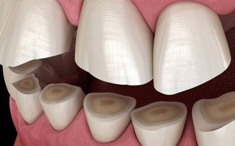  The Best Night Guard for Teeth Grinding