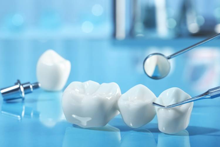 All about overhanging dental crown