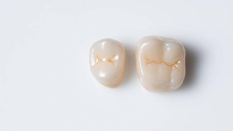 All things you should know about Overhanging dental crown