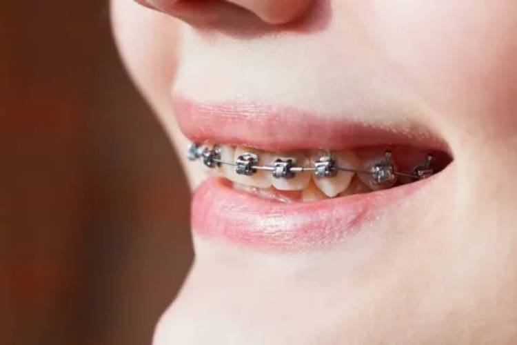 Self-ligating braces vs traditional braces