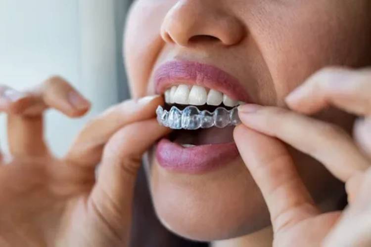 CDCP Invisalign; full guide