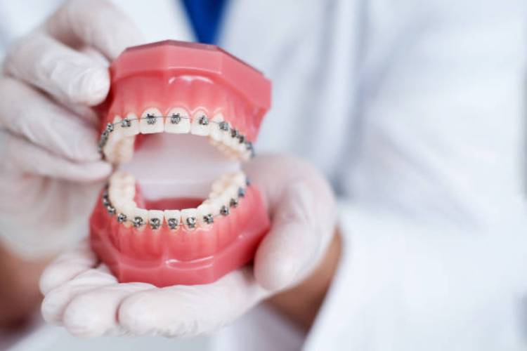 All about CDCP braces