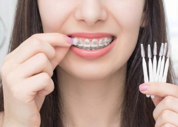 Self-ligating braces vs traditional braces