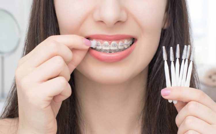  Self-Ligating Braces vs Traditional Braces: Benefits, Cost & Treatment