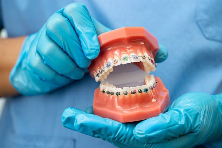 Self-ligating braces vs traditional braces