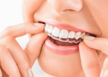 CDCP Invisalign; complete guide