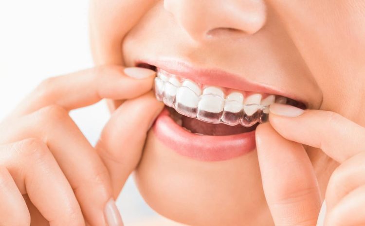  CDCP Invisalign: What Most Canadians Don’t Know About Coverage