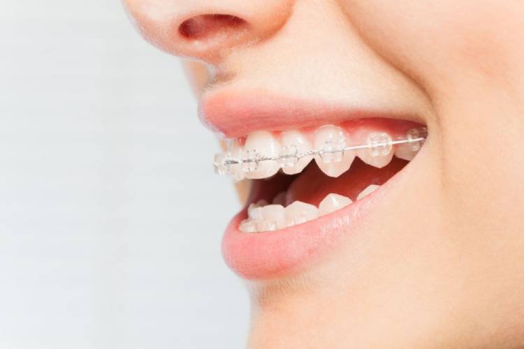 CDCP braces; what you should know about